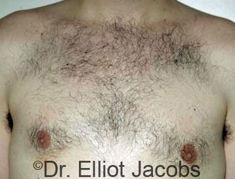 Male breast, after Gynecomastia treatment, front view, patient 8