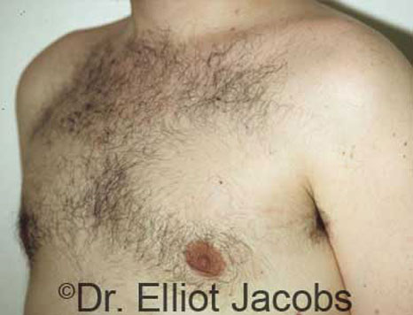 Male breast, after Gynecomastia treatment, l-side oblique view - patient 8