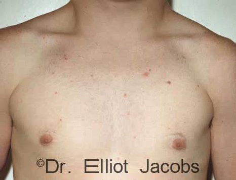 Men's breast, after Gynecomastia Adolescent treatment, front view - patient 1