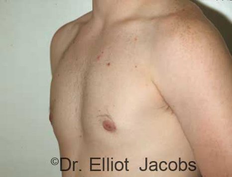 Men's breast, after Gynecomastia Adolescent treatment, oblique view - patient 1