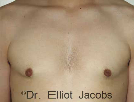 Male breast, after Gynecomastia treatment, front view, patient 81