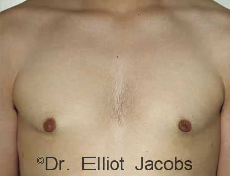 Male breast, after gynecomastia Adolescent treatment, front view, patient 2