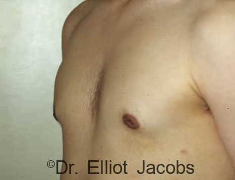Men's breast, after Gynecomastia Adolescent treatment, oblique view - patient 2