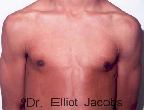 Male breast, after Adolescent Gynecomastia treatment, front view, patient 1