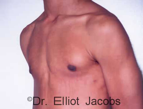 Male breast, after Gynecomastia treatment, l-side oblique view - patient 82