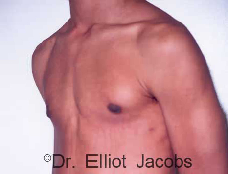 Men's breast, after Gynecomastia Adolescent treatment, oblique view - patient 3