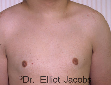 Male breast, after Gynecomastia treatment, front view, patient 83