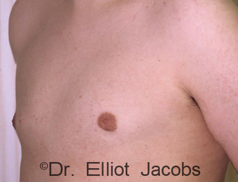 Male breast, after Gynecomastia treatment, l-side oblique view - patient 83