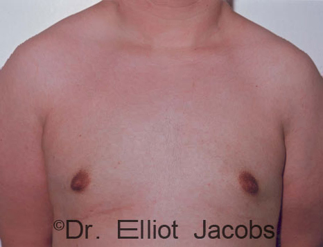 Male breast, after Gynecomastia treatment, front view, patient 84
