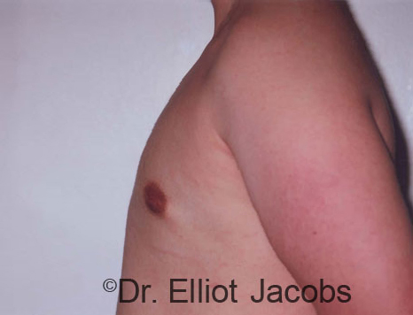 Men's breast, after Gynecomastia Adolescent treatment, oblique view - patient 5