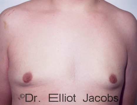 Male breast, after Gynecomastia treatment, front view, patient 85