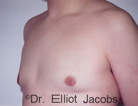 Men's breast, after Gynecomastia Adolescent treatment, oblique view - patient 6