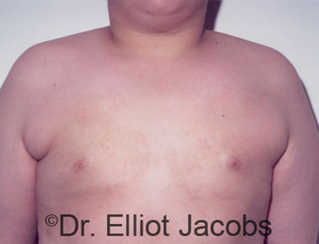 Male breast, after Gynecomastia treatment, front view, patient 86