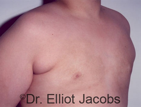 Male breast, after Gynecomastia treatment, r-side oblique view - patient 86