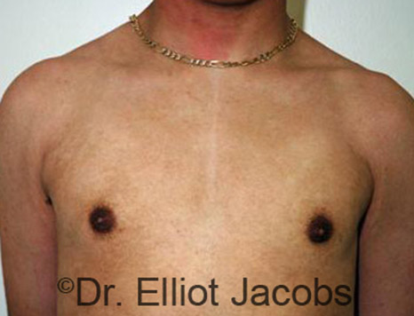 Men's breast, after Gynecomastia Adolescent treatment, front view - patient 8