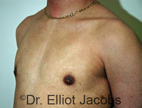 Men's breast, after Gynecomastia Adolescent treatment, oblique view - patient 8