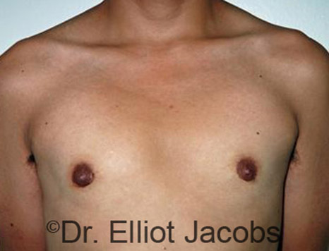 Men's breast, after Gynecomastia Adolescent treatment, front view - patient 9