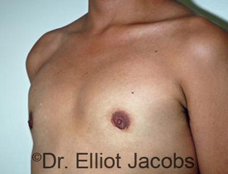Men's breast, after Gynecomastia Adolescent treatment, oblique view - patient 9