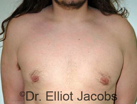 Men's breast, after Gynecomastia Adolescent treatment, front view - patient 10