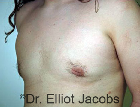 Men's breast, after Gynecomastia Adolescent treatment, oblique view - patient 10