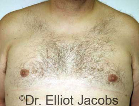Male breast, after Gynecomastia treatment, front view, patient 9