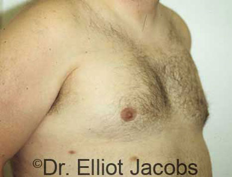 Male breast, after Gynecomastia treatment, r-side oblique view - patient 9