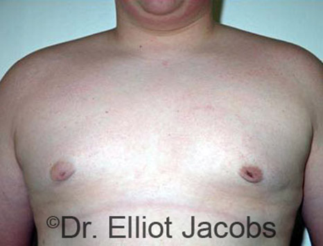 Men's breast, after Gynecomastia Adolescent treatment, front view - patient 11