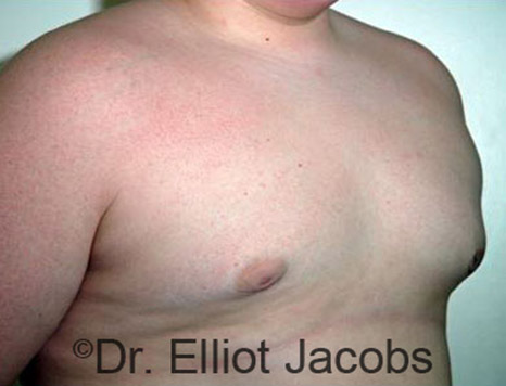 Men's breast, after Gynecomastia Adolescent treatment, oblique view - patient 11