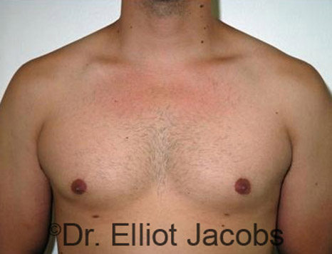Men's breast, after Gynecomastia Adolescent treatment, front view - patient 12