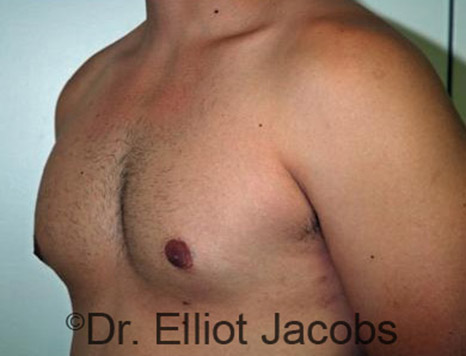 Men's breast, after Gynecomastia Adolescent treatment, oblique view - patient 12