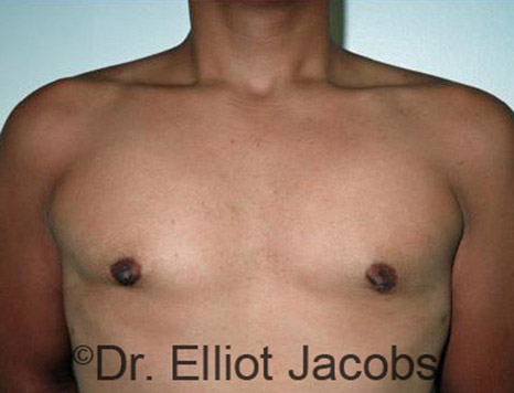 Men's breast, after Gynecomastia Adolescent treatment, front view - patient 13