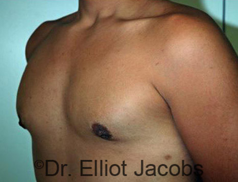 Men's breast, after Gynecomastia Adolescent treatment, oblique view - patient 13