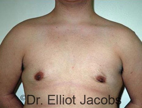 Men's breast, after Gynecomastia Adolescent treatment, front view - patient 14