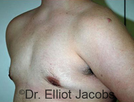 Men's breast, after Gynecomastia Adolescent treatment, oblique view - patient 14