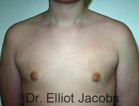 Men's breast, after Gynecomastia Adolescent treatment, front view - patient 15