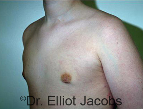 Men's breast, after Gynecomastia Adolescent treatment, oblique view - patient 15