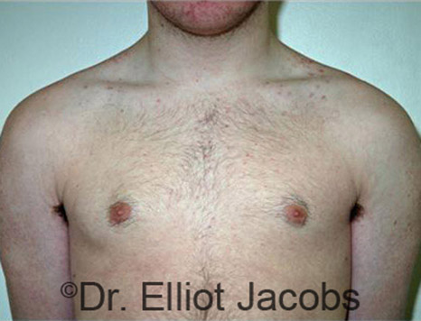 Men's breast, after Gynecomastia Adolescent treatment, front view - patient 16