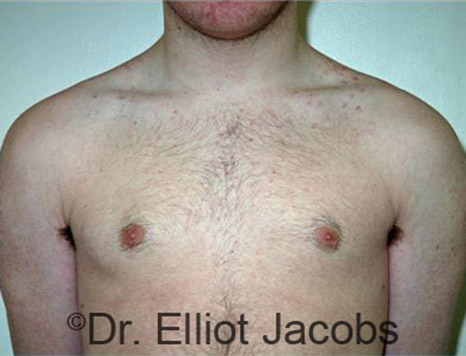 Men's breast, after Gynecomastia Adolescent treatment, front view - patient 16