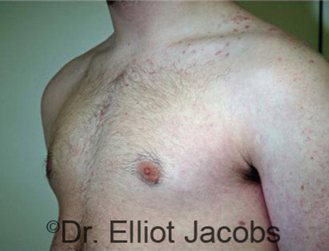 Men's breast, after Gynecomastia Adolescent treatment, oblique view - patient 16