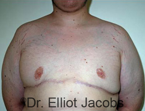 Men's breast, after Gynecomastia Adolescent treatment, front view - patient 17