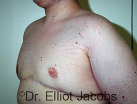 Men's breast, after Gynecomastia Adolescent treatment, oblique view - patient 17