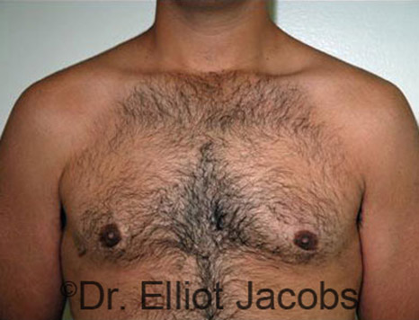 Men's breast, after Gynecomastia Adolescent treatment, front view - patient 18