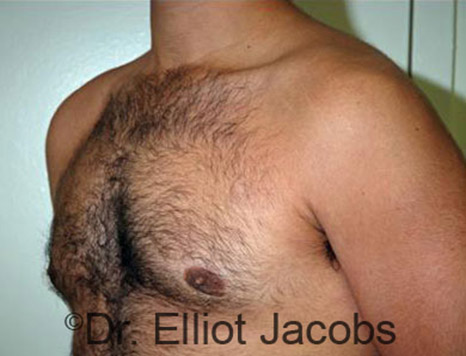 Men's breast, after Gynecomastia Adolescent treatment, oblique view - patient 18