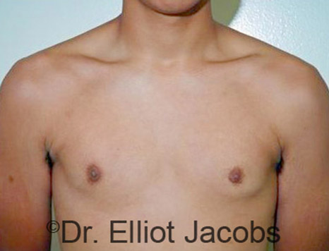 Men's breast, after Gynecomastia Adolescent treatment, front view - patient 19