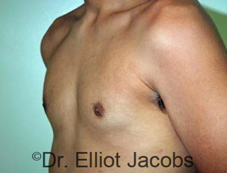 Men's breast, after Gynecomastia Adolescent treatment, oblique view - patient 19