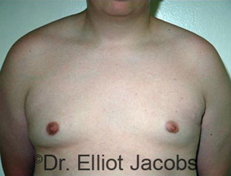 Male breast, after Adolescent Gynecomastia treatment, front view, patient 2