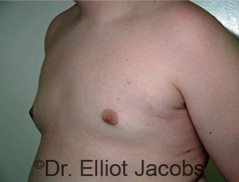 Men's breast, after Gynecomastia Adolescent treatment, oblique view - patient 20