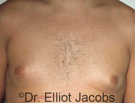 Male breast, before Gynecomastia treatment, front view, patient 10