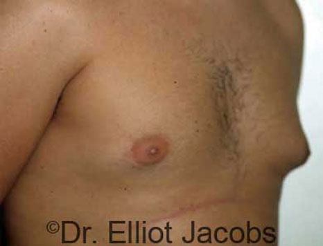 Male breast, before Gynecomastia treatment, r-side oblique view - patient 10