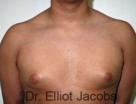 Men's breast, before Gynecomastia Adolescent treatment, front view - patient 21